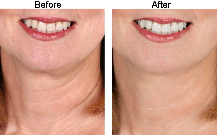 Before and After Teeth And Neck